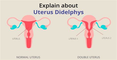 Uterus Didelphys: Causes, Symptoms, Diagnosis & Treatment